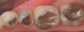 View of fillings at x2 magnification with Microscope Dentistry. The first image is twice the normal size of real teeth. Working as a dentist at this magnification is a great help.