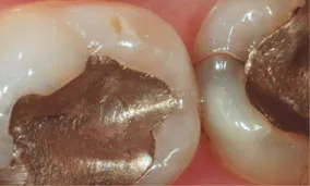 View of fillings at x8 magnification with Microscope Dentistry. However when detail is required for diagnosis or for maximum precision x8 magnification will facilitate greater control.