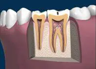 Early Stages of Tooth Decay