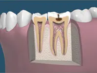 Mid Stages of Tooth Decay