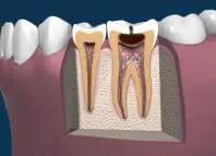 Late Stages of Tooth Decay