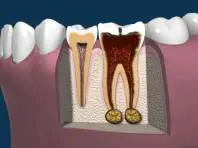 Late Stages of Tooth Decay with Diseased Bone