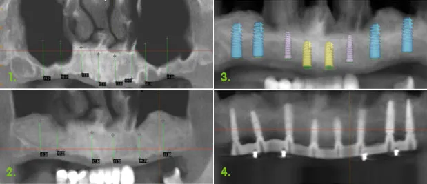 Bone Grafts & Sinus Grafts at Gate Dental Clinic Galway