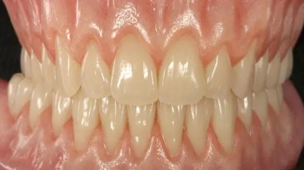 Real Life Denture By Dr Paul Moore - Gate Dental Clinic Galway