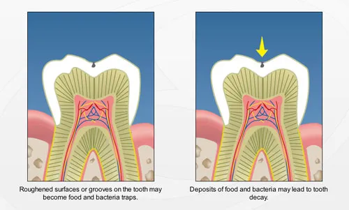 Dental Sealants - Gate Dental Clinic Galway