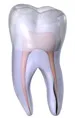 Vertical Root Fracture - a vertical root fracture begins at the root and extends towards the chewing surface of the tooth.