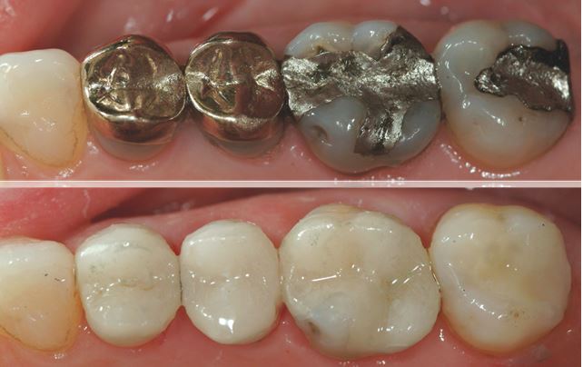 Discoloured Teeth