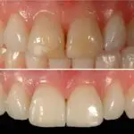 Discoloured Teeth