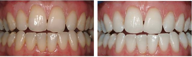 Discoloured Teeth