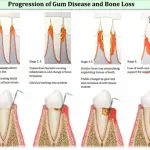 Gum disease and bone loss