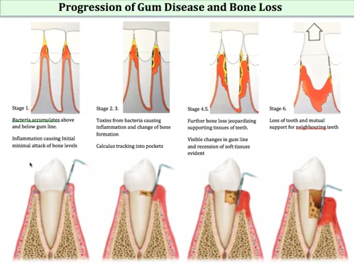 Gum disease and bone loss