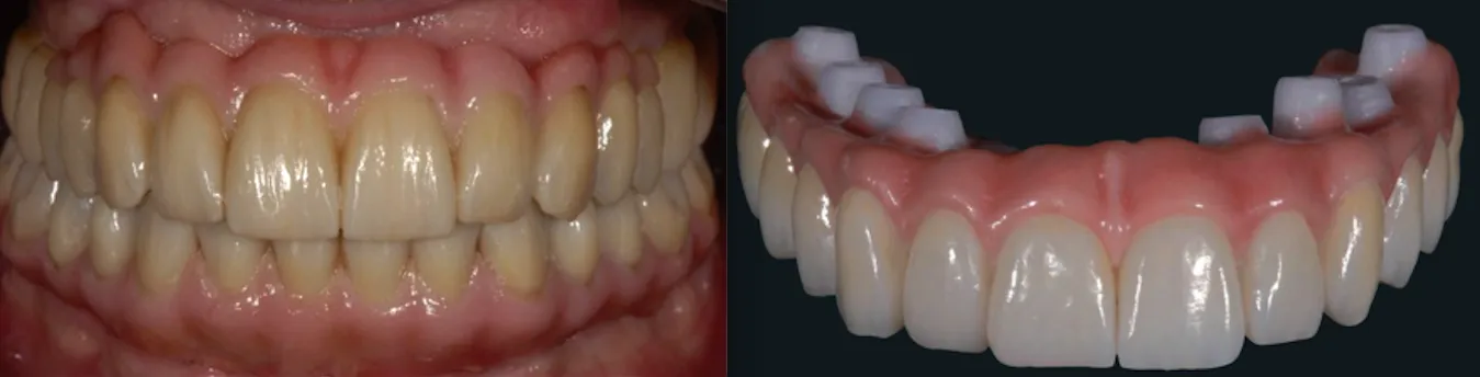 Dental Implant 3D Model Screenshot
