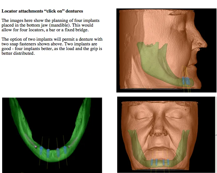 Dental implants galway