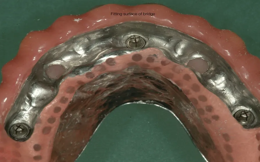 Dental implants Galway