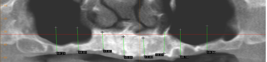 Dental implants Galway