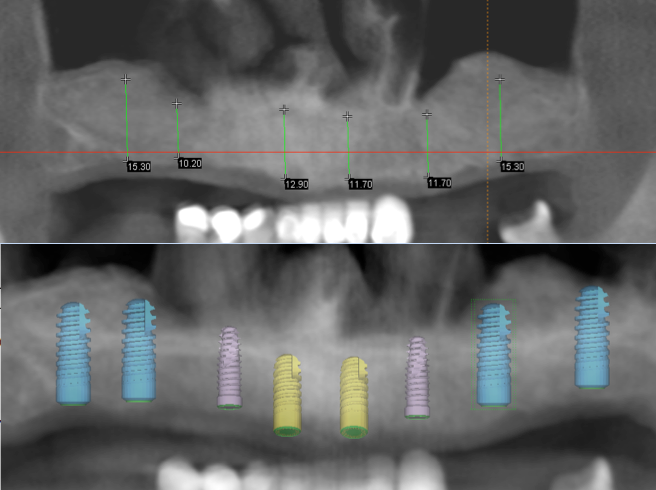 To place the sinus graft we make small incisions in the gum and there is a thin membrane in the sinus that is lifted gently. A granular bone “scaffolding” is then placed. This surgical procedure is completed under sedation.