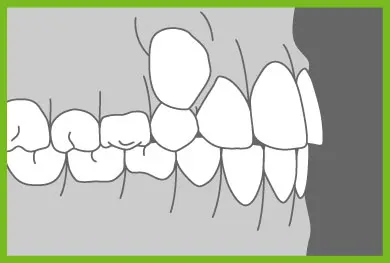 Common Ortho Problems - Abnormal Eruption