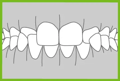 Common Ortho Problems - Crossbite