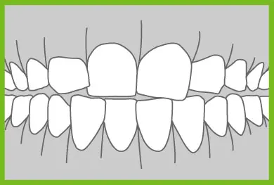 Common Ortho Problems - Crowding