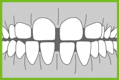 Common Ortho Problems - Excessive Spacing