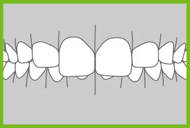 Common Ortho Problems - Overbite