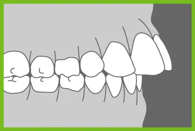 Common Ortho Problems - Overjet