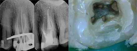 An upper first molar case with 5 canals