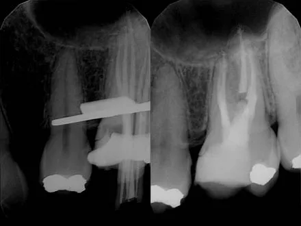 An upper first molar with fractured file in DB1 canal and 5 canals re-treatment