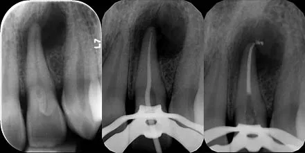 Apicoectomy case with MTA of upper lateral incisor and removal of cyst