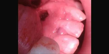 Apicoectomy case with MTA of upper lateral incisor and removal of cyst