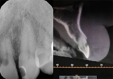 External cervical root resporption, CBCT imaging and composite repair at the end
