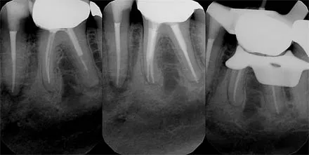 Removal of a fractured file from lower first molar and re-treatment