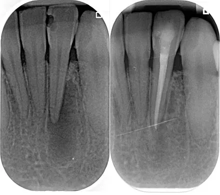 Lower lateral incisor and healing lesion x-ray 12 month post treatment