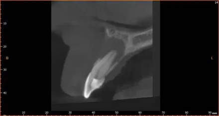Removal of a fractured file from lower first molar and re-treatment