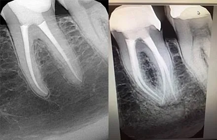 Root treatment of lower first molar