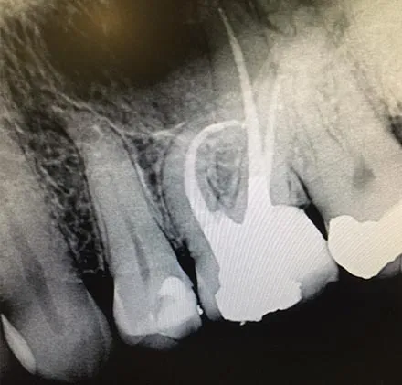 Root treatment of lower first molar