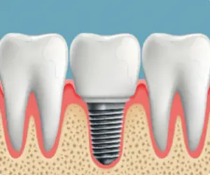 Dental Implants