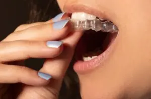 Invisalign Aligners